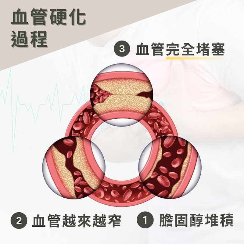 血管硬化的過程。